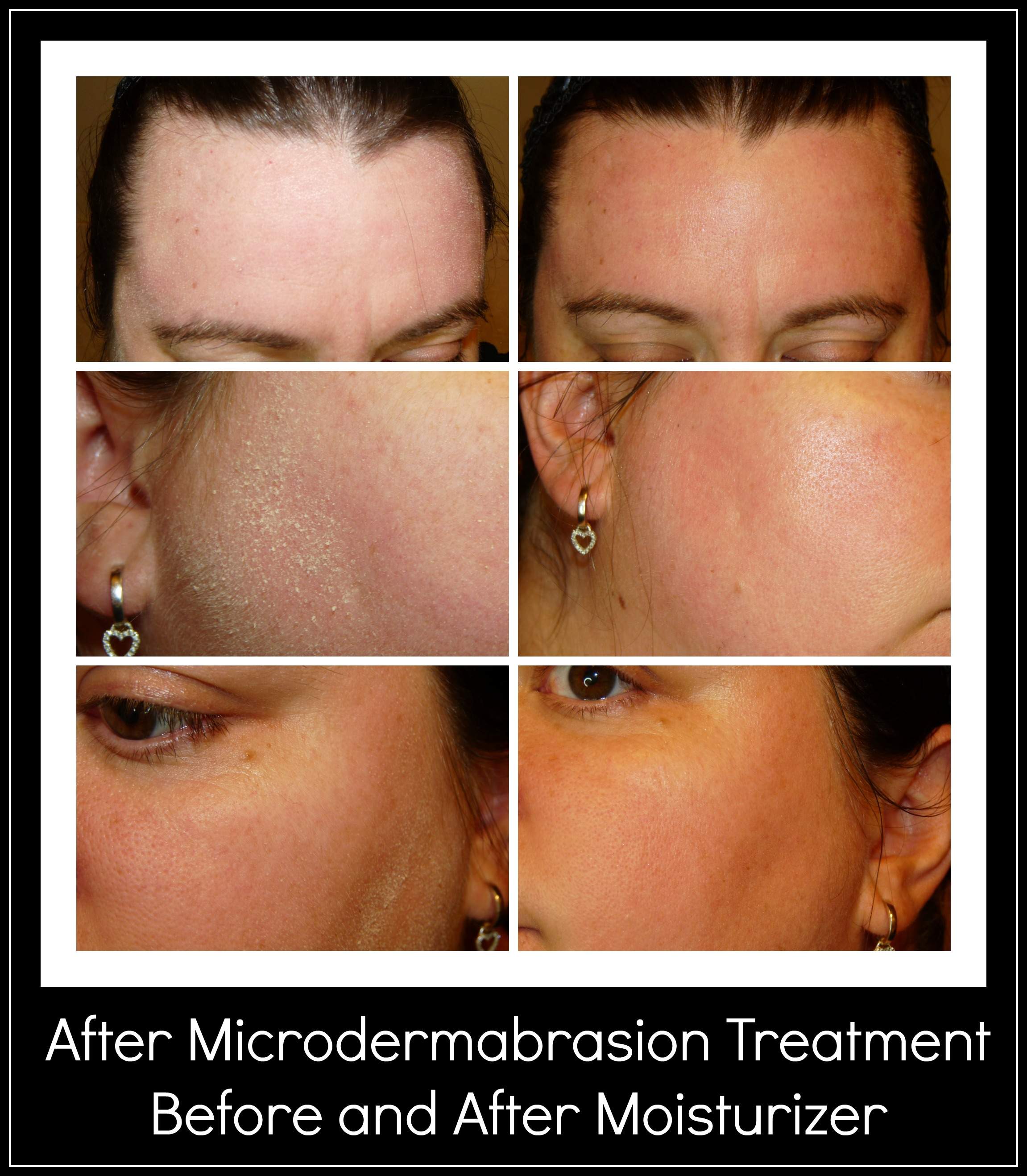 The Pore Cleaning Microdermabrasion System Review Coris Cozy Corner