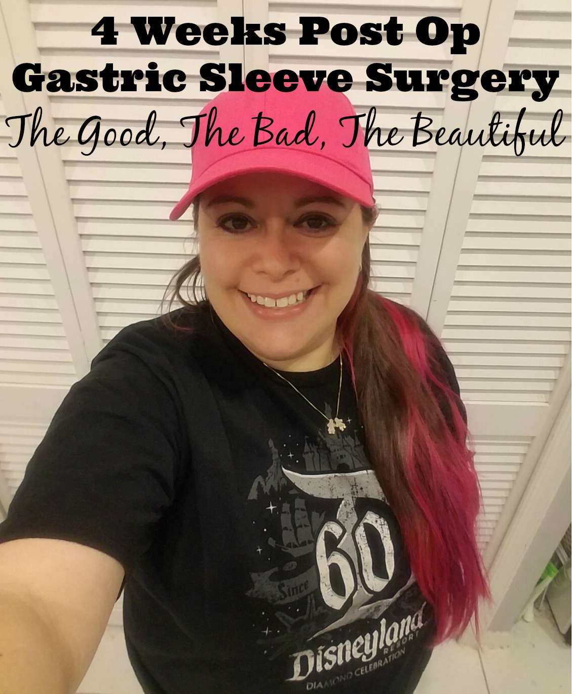 No Weight Loss 3 Weeks After Gastric Sleeve Surgery