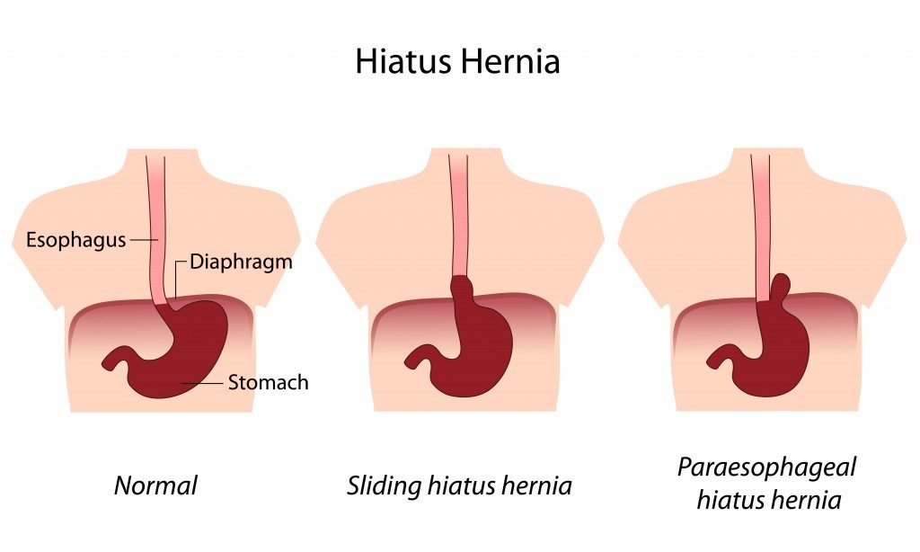 hiatal hernia